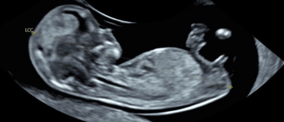 L'échographie du 1er Trimestre - Esterel Échographie L'échographie du 1er Trimestre - Esterel Échographie